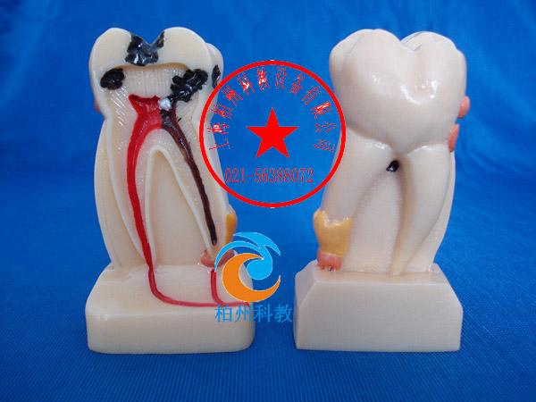 供應4倍牙體綜合病理模型