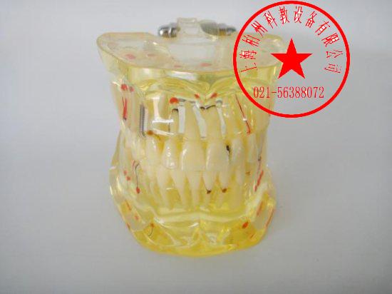 供應(yīng)透明牙體病理模型