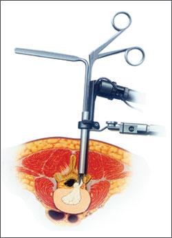 供應(yīng)椎間孔鏡技術(shù)·椎間孔鏡療法