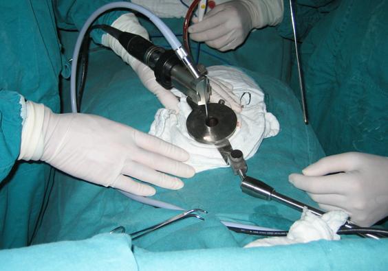 供應(yīng)椎間孔鏡的*方法