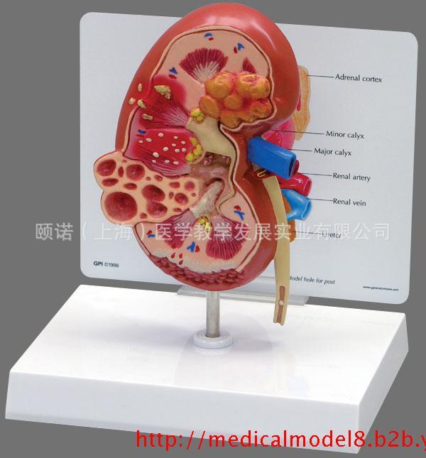 *病變模型病理腎腎病理腎結(jié)石模型腎解剖模型盈諾實業(yè)