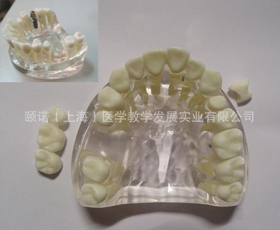 牙科种植演示模型 冠桥 种植演示 瓷贴片 口腔科医患沟通