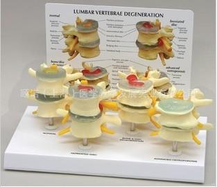ENOVO正品 医用腰椎正常与病变组合模型 腰椎 骨科教学骨骼模型图片