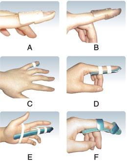 手指矫形器包含腕掌固定矫形器, 腕掌动态矫形器,手指固定矫形器