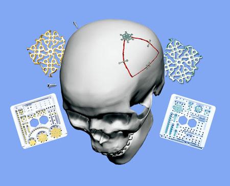 供应颅骨固定钛金系统