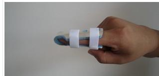 供應(yīng)手指夾板手指矯形器