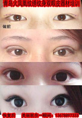 雙眼皮圖片/雙眼皮樣板圖 (2)